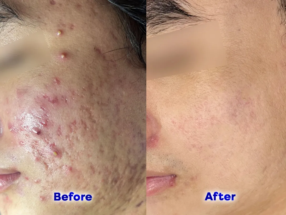 Ca sẹo rỗ hỗn hợp vùng má trước và sau 6 buổi trị sẹo rỗ tại S Beauty Thủ Đức