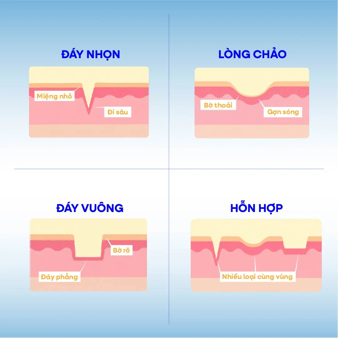 Đồ hoạ bốn loại sẹo rỗ: đáy nhọn, đáy vuông, lòng chảo, hỗn hợp